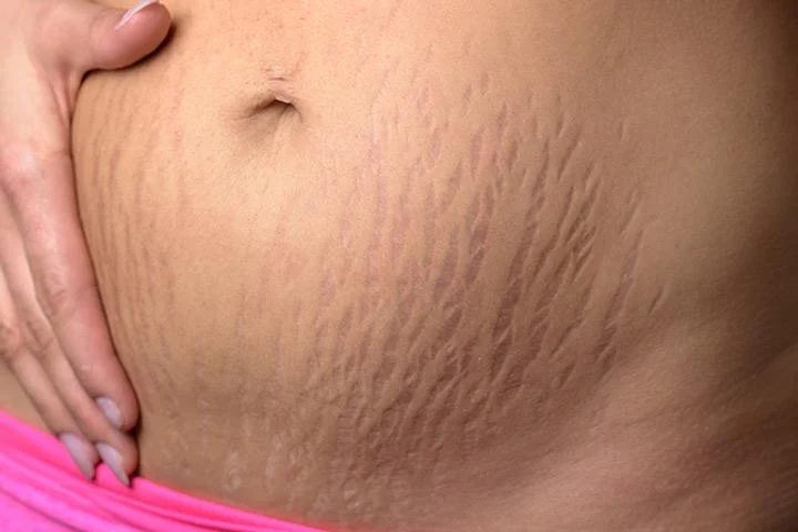 Image result for stretch marks pregnancy